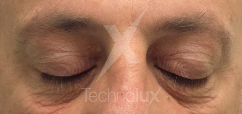 Xantelasma-post-1.jpg